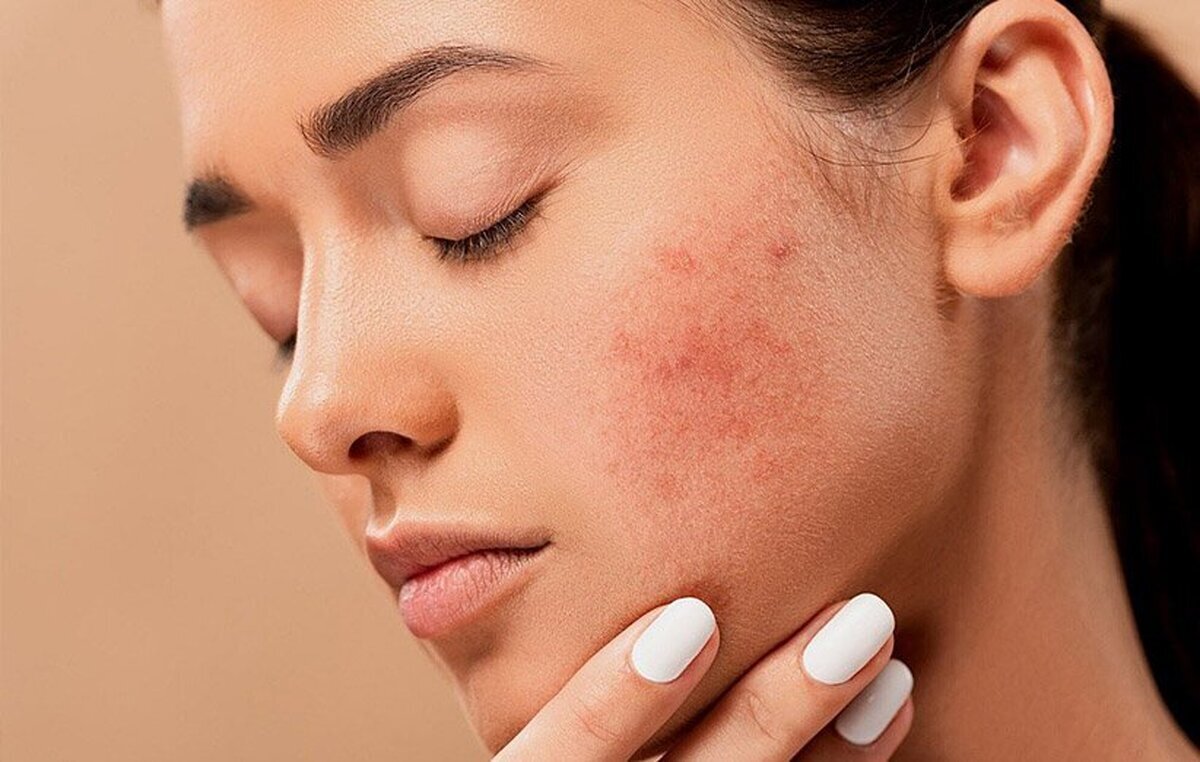 غذاهایی شگفت انگیز برای کنترل آکنه هورمونی