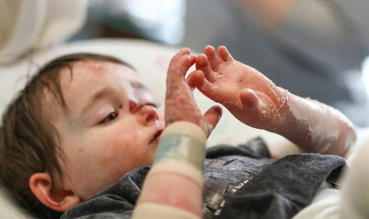 آیا بیماری پروانه‌ای واگیردار است؟