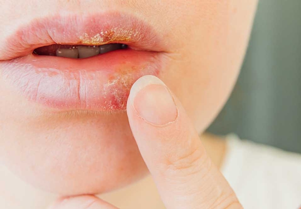 مبارزه با ویروس آنفلوآنزا و تبخال با آدامس لوبیا!