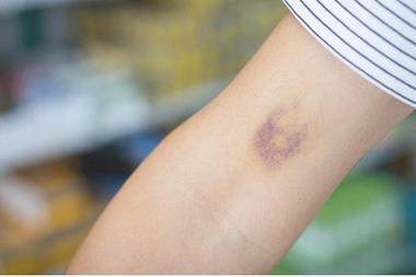 علت کبودی بی‌دلیل در بدن چیست؟