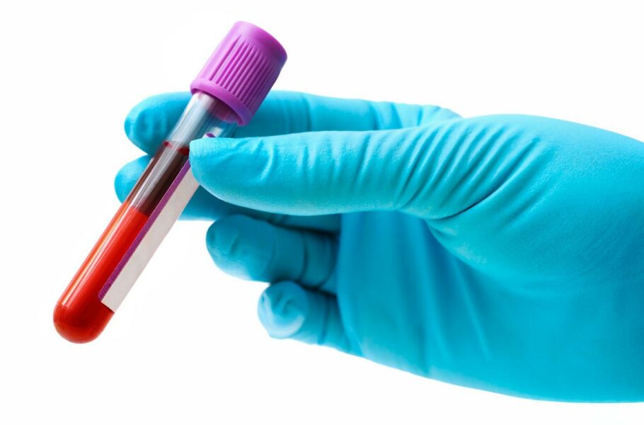 این آزمایش خون جدید می‌تواند بازگشت سرطان سینه را از سه سال زودتر پیش‌بینی کند