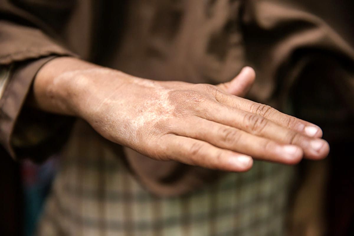 آیا بیماری جذام، قابل درمان است؟