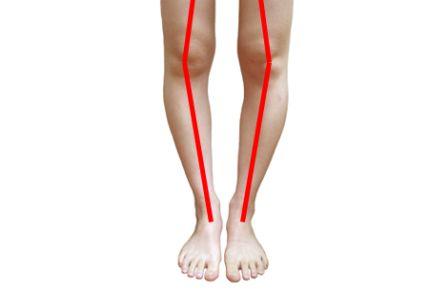 کمبود این ویتامین پا را پرانتزی می‌کند!