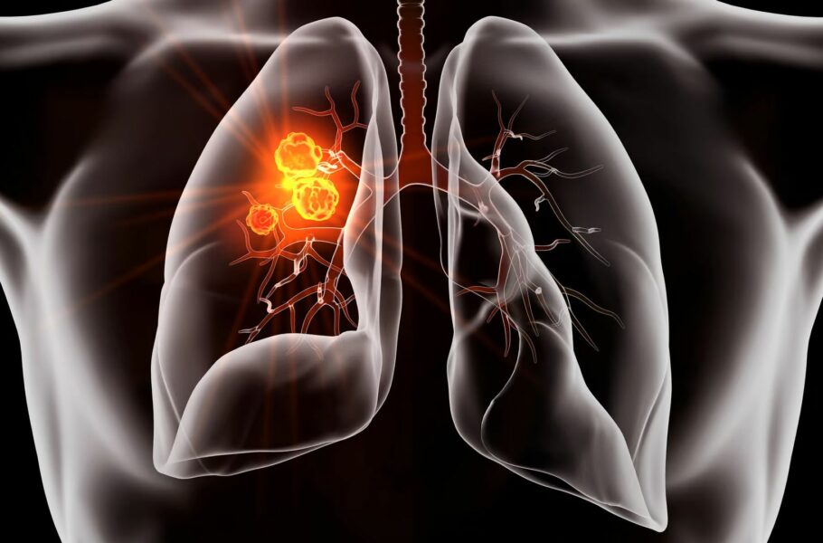 قرص جدید سرطان ریه در آزمایش‌های بالینی عملکرد قابل‌توجهی از خود نشان داد